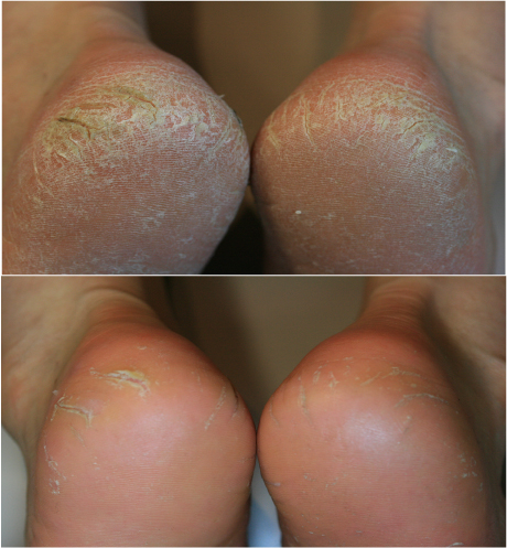 After peel off calluses, the client's feet become more sensitive.